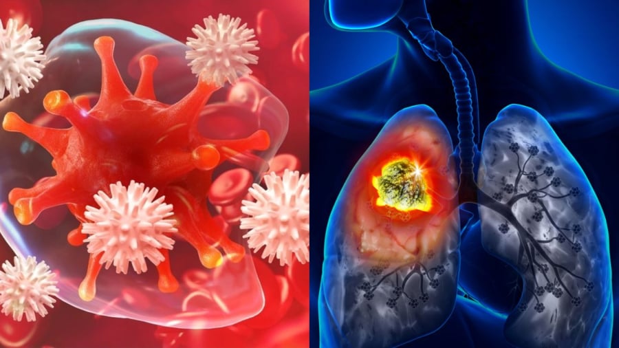 Ung thư phổi là loại ung thư phổ biến và có nguy cơ tử vong cao.