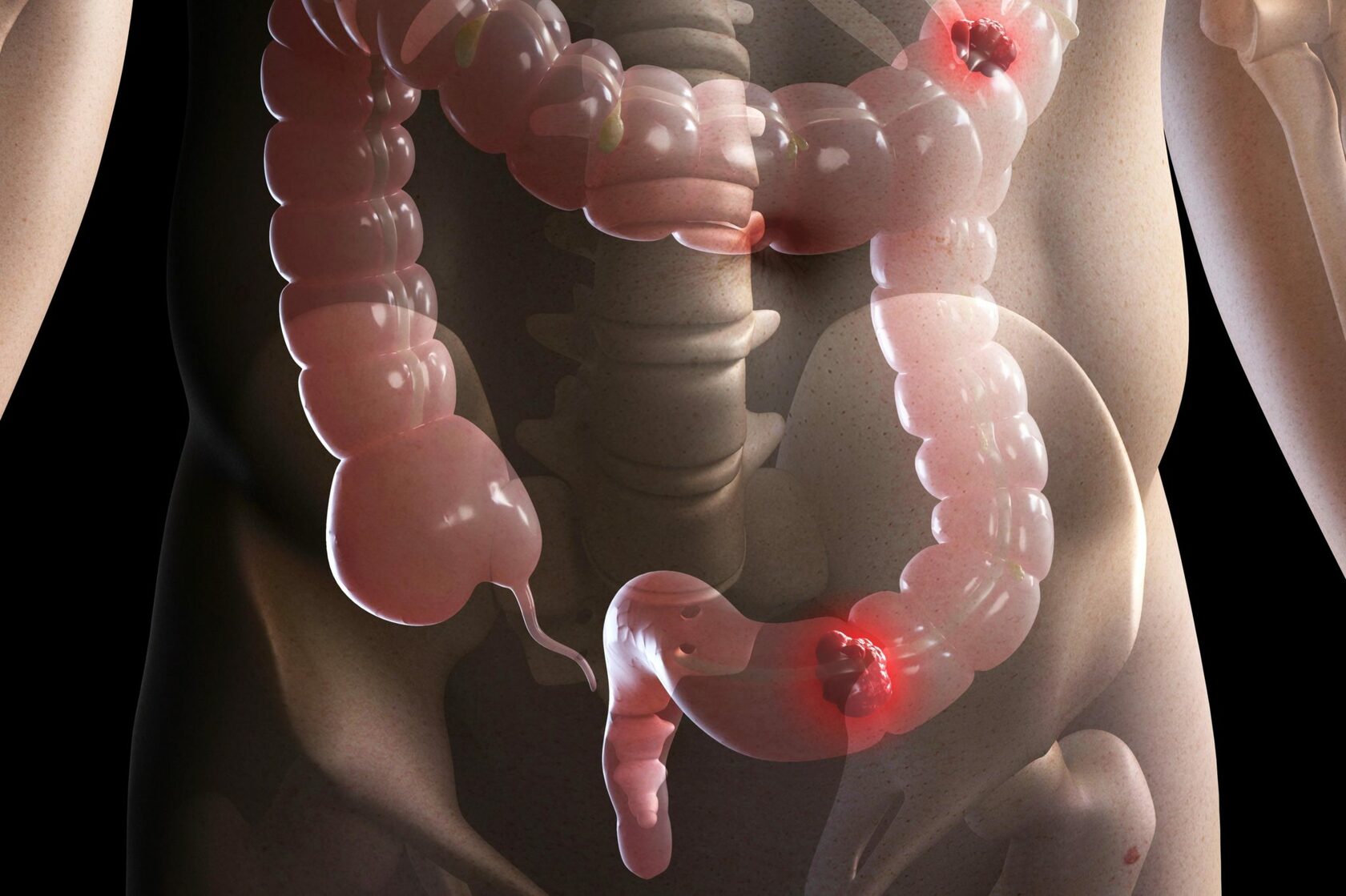 Phát hiện ung thư giai đoạn 4 ở tuổi 26, nam thanh niên hối hận: Giá như tôi không bỏ qua triệu chứng này - Ảnh 2.